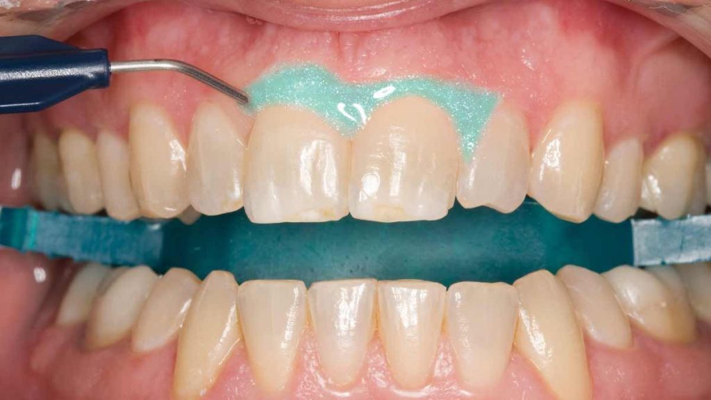 استفاده از سفید کننده های دندان در خانه